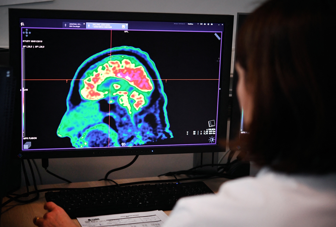 En läkare studerar hjärnan på en patient med hjälp av en PET-kamera. Undersökningar har indikerat att hjärnan är mer mottaglig och mindre kritisk medan man ser på tv. Foto: Fred Tanneau/AFP via Getty Images