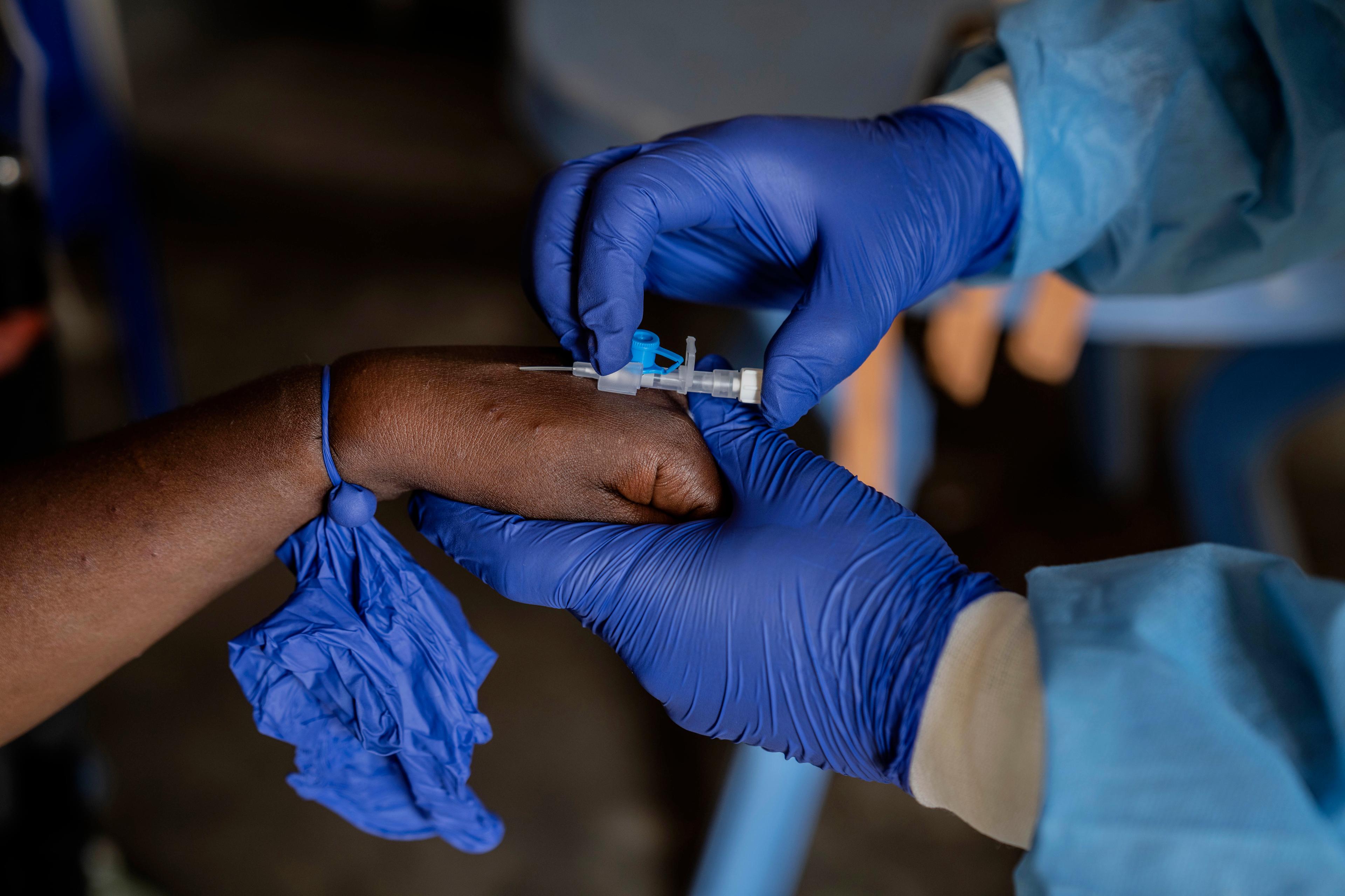 En sjukvårdare behandlar en patient för mpox i det hårt drabbade hårt drabbade Kongo-Kinshasa. Bilden är tagen i augusti. Foto: Moses Sawasawa/AP/TT