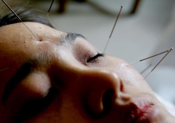 

En kvinna får akupunkturbehandling i Xian, Kina. Akupunktur hjälper mot reumatism, som i Kina kallas för "sjukdom av vind och fukt". Foto: China Photos/Getty Images                                                                                            