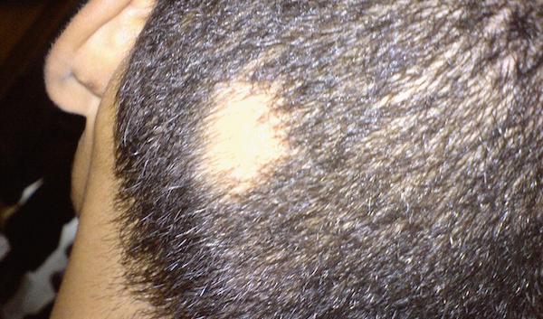 



Alopecia areata.                                                                                                                                                                                    
