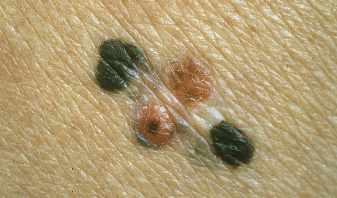 Australienska forskare har utvecklat ett nytt blodtest som ska kunna identifiera tidiga symptom på hudcancerformen malignt melanom. Foto: Mats Bjellerup/1177 Vårdguiden