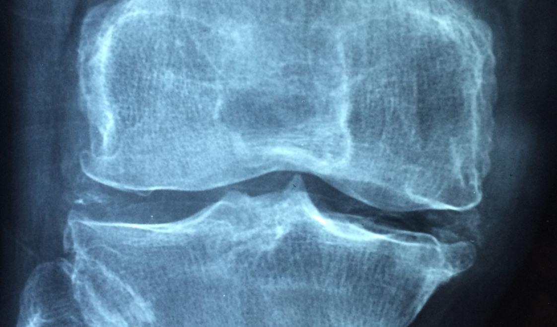 



Osteoporos orsakar gradvis förlust av bentäthet och styrka. När bröstkörtlarna påverkas kan det finnas en gradvis kollaps av ryggkotorna. Detta resulterar i kutryggighet.                                                                                                                                                                                         