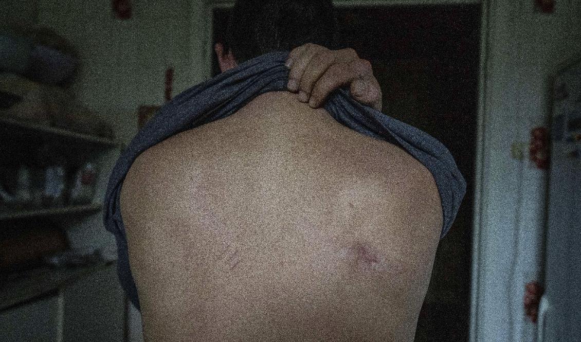 Mykola Mosyakyn visar upp sin ärrade rygg. Mosyakyn uppger att han torterats av ryska soldater i ukrainska Izium, som befriades från rysk ockupation i september. Foto: Evgeniy Maloletka/AP/TT
