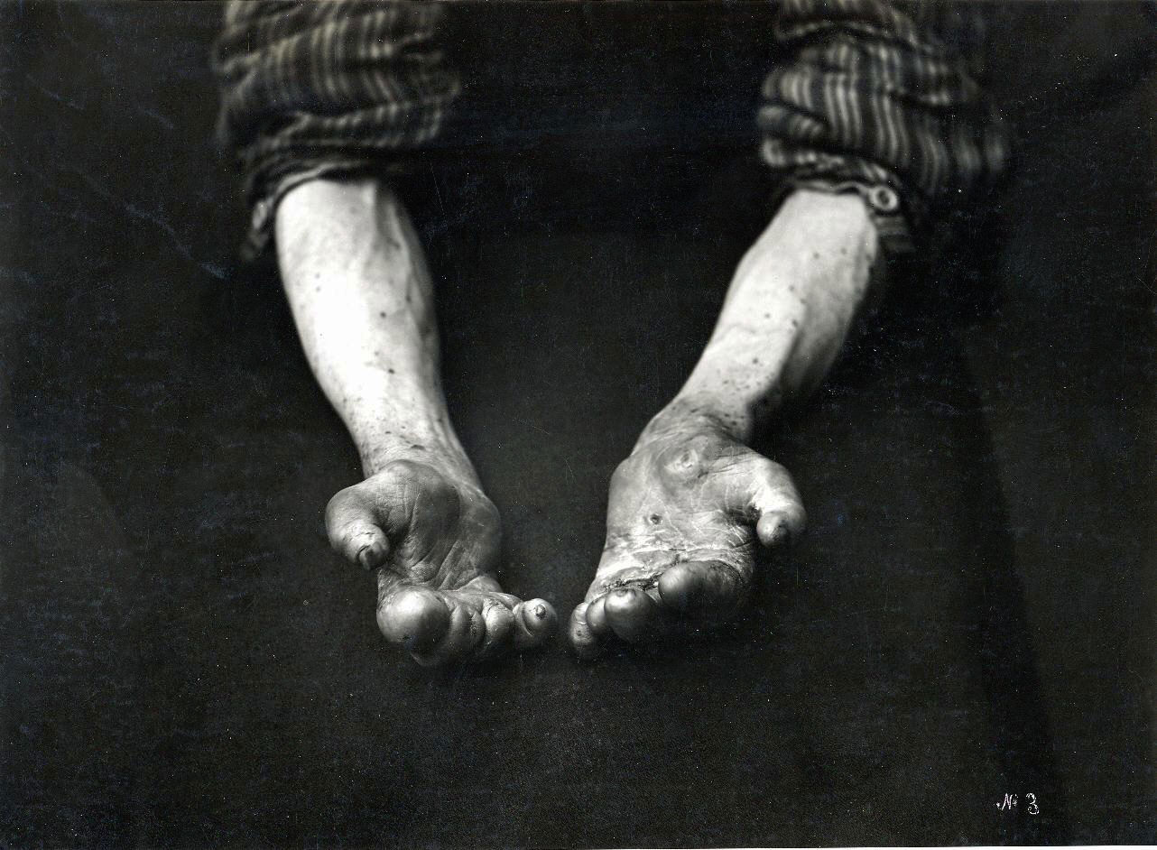 Händerna på en leprapatient. Bild från lepramuseet i norska Bergen. Foto: Bergen Museum/NTB/TT