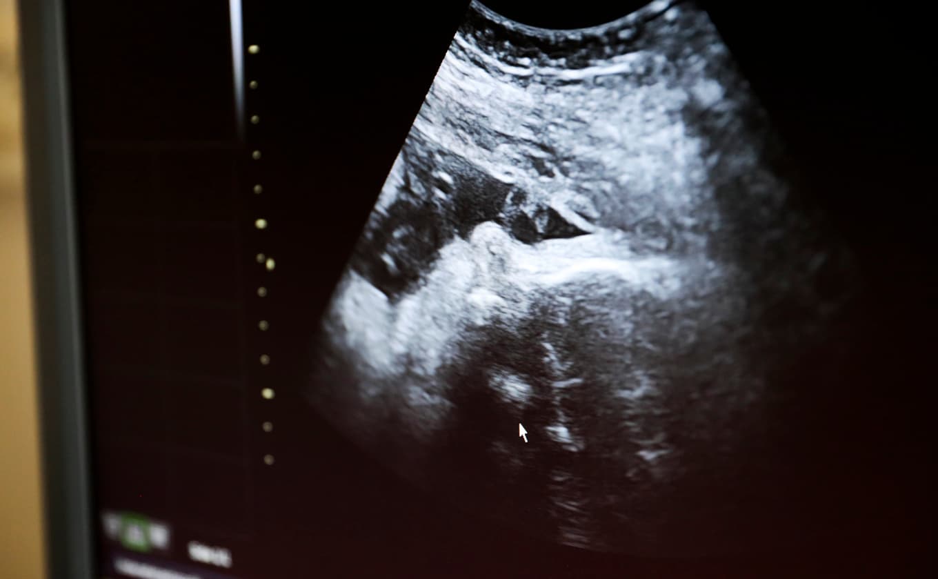 Flera regioner ska fasa ut fosterdiagnostiktestet kub. Arkivbild. Foto: Lise Åserud / NTB scanpix / TT