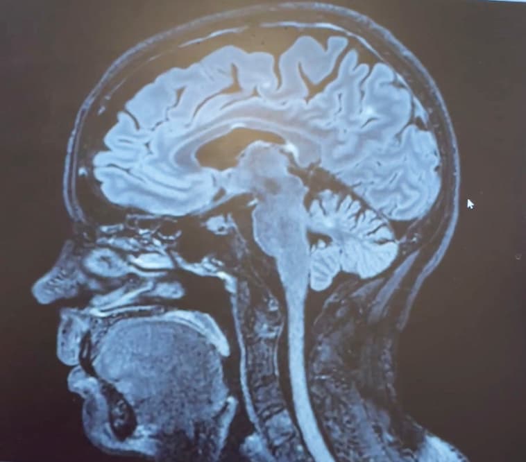 Vita fläckar indikerar var sjukdomen ms har skadat personens hjärnvävnad. På bilder av någon med diagnosen schizofreni har förändringar inte påträffats. Foto: Privat